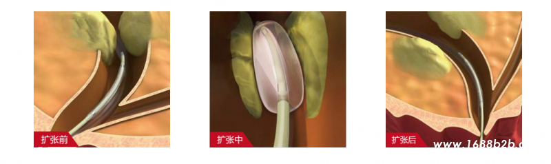 扩张球囊